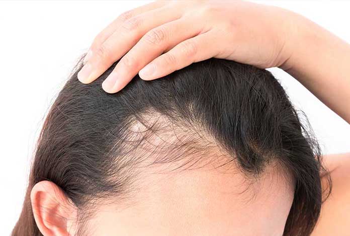 ریزش مو زنان - درمان ریزش مو زنان- ریزش مو در زنان